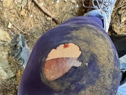 My bloody and bruised knee after a fall down a narrow mountain path.